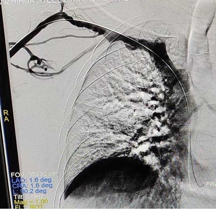 術后造影右鎖骨下靜脈狹窄完全打開
